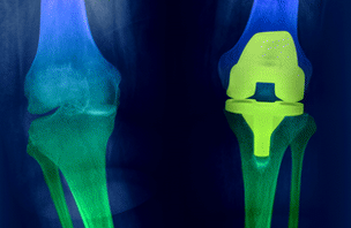 Doktori témakiírás: Térdprotézis kopás és kilazulás általi tönkremenetelének numerikus vizsgálata